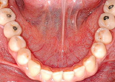Zahnimplantate Implantatbehandlungen Zahnarzt-Praxisgemeinschaft Dr. Probst Derendingen