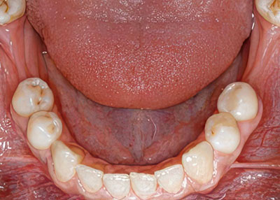 Zahnimplantate Implantatbehandlungen Zahnarzt-Praxisgemeinschaft Dr. Probst Derendingen