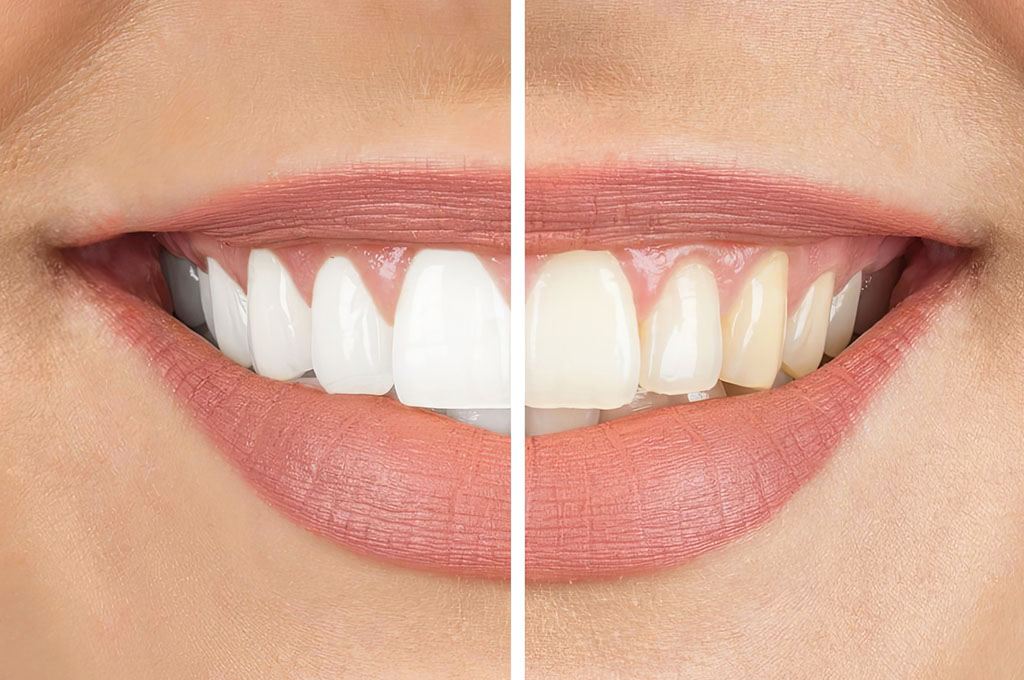 Vor und nach Bleachingbehandlung zahnarztpraxisgemeinschaft dr. probst derendingen zahnarzt in solothurn