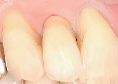 Implantate Zahnarzt-Gemeinschaftspraxis Dr. Probst Solothurn Derendingen
