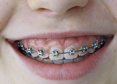 Kieferorthopädie Zahnspange in der Zahnarzt-Praxisgemeinschaft Dr. Probst Derendingen Solothurn